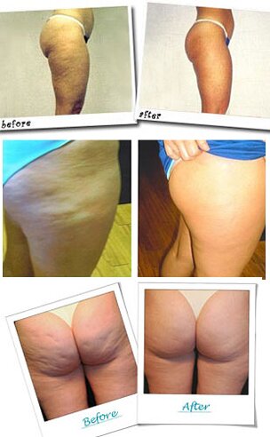 revitol-cellulite-cream-before-after-image