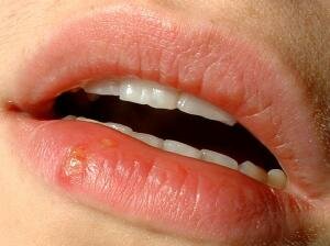How to Get Rid Of Herpes?